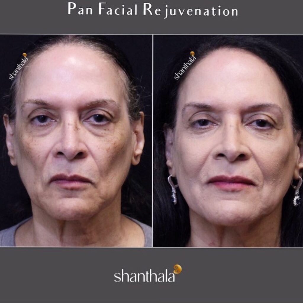 Vampire Facelift By Dr. Shanthala - ShanthalaMD Laser & Aesthetic Center Peabody, Boston, MA liquid facelift Boston Expert
