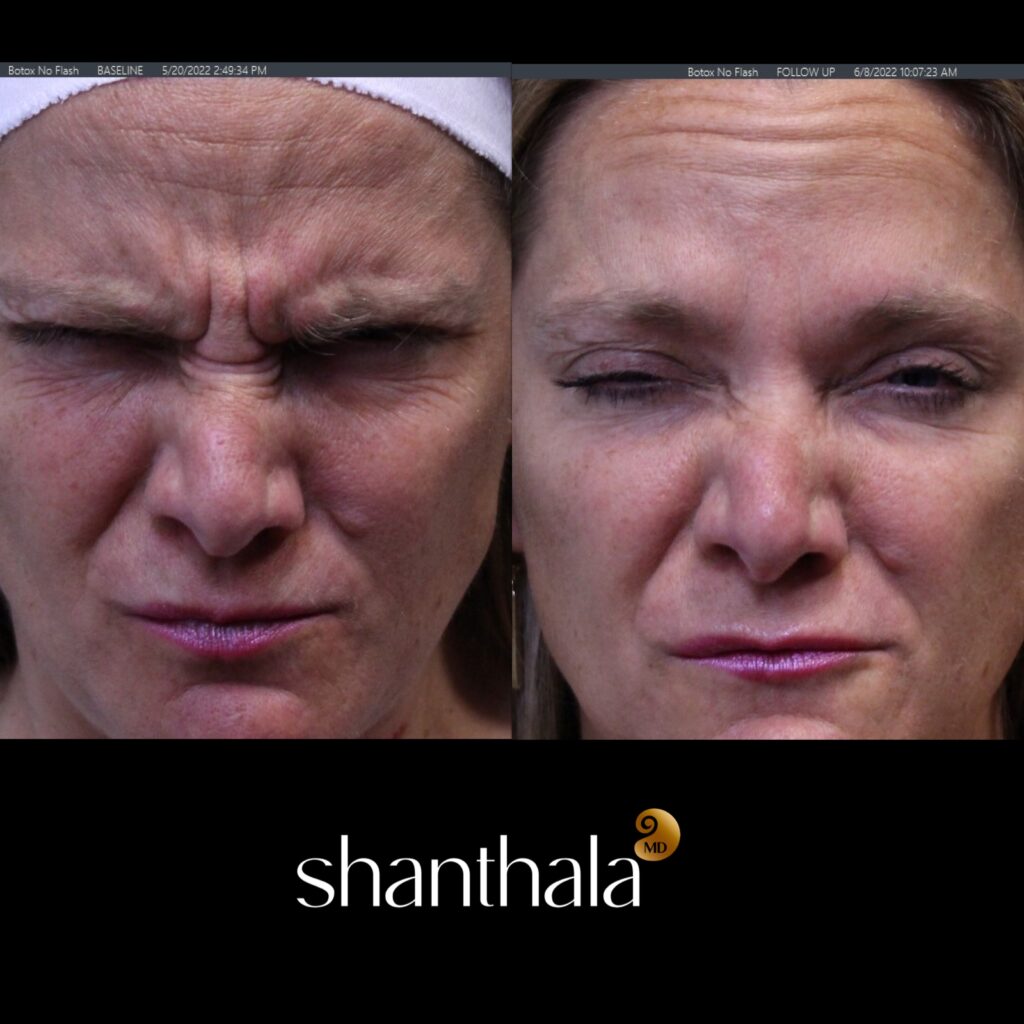 Top MD Botox Specialist Boston - ShanthalaMD Laser & Aesthetic Center Peabody, Boston, MA Best Botox in Boston by Dr. Shanthala