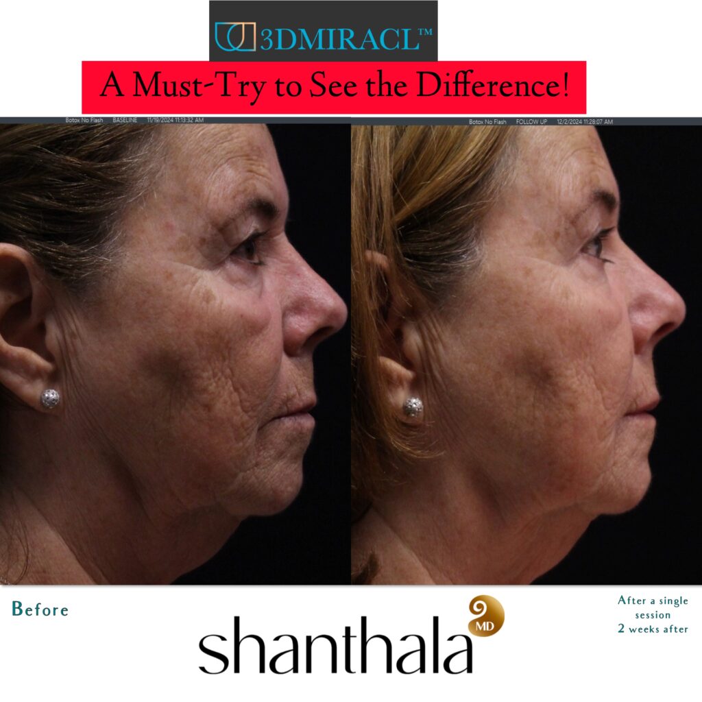 3D Miracle Laser Cost & Reviews on RealSelf ShanthalaMD