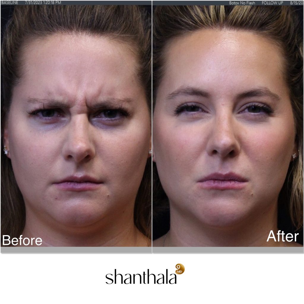 IMG_6468 - ShanthalaMD Laser & Aesthetic Center Peabody, Boston, MA Top Botox Specialist in Boston