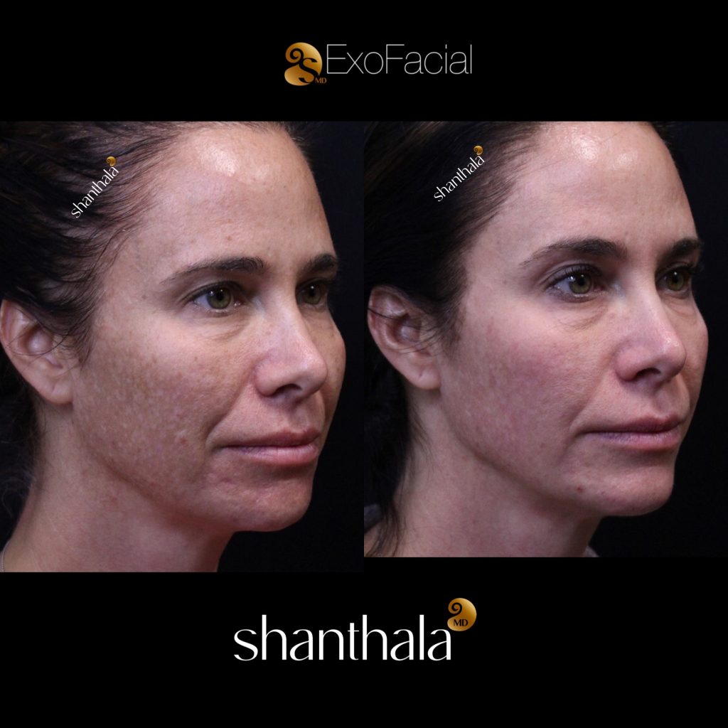 Skinpen Microneedling by Dr. Shanthala - ShanthalaMD Laser & Aesthetic Center Peabody, Boston, MA SkinPen Microneedling with Topical Exosomes