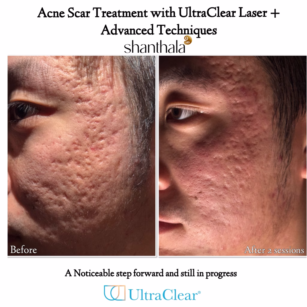 IMG_2144 - ShanthalaMD Laser & Aesthetic Center Peabody, Boston, MA Best Acne Scar Treatments New England, MA